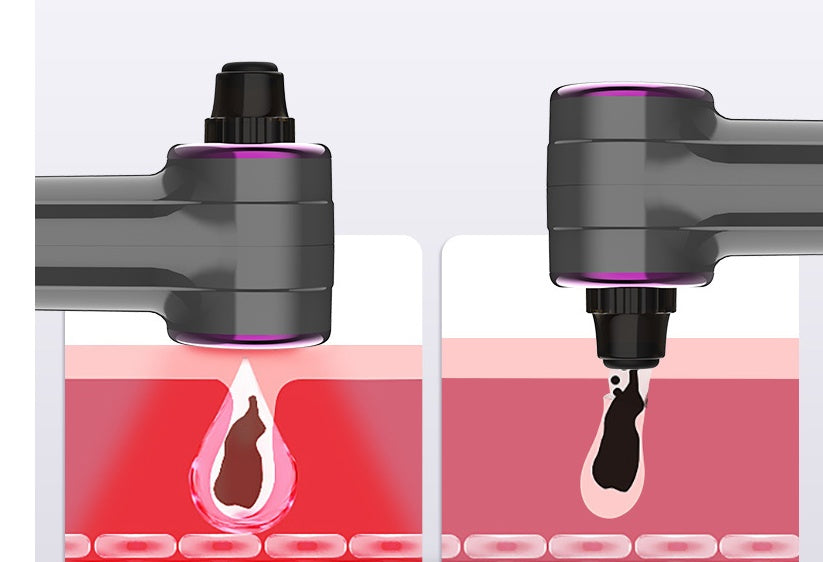 Nouveau dispositif électrique d'aspiration de points noirs et nettoyage des pores